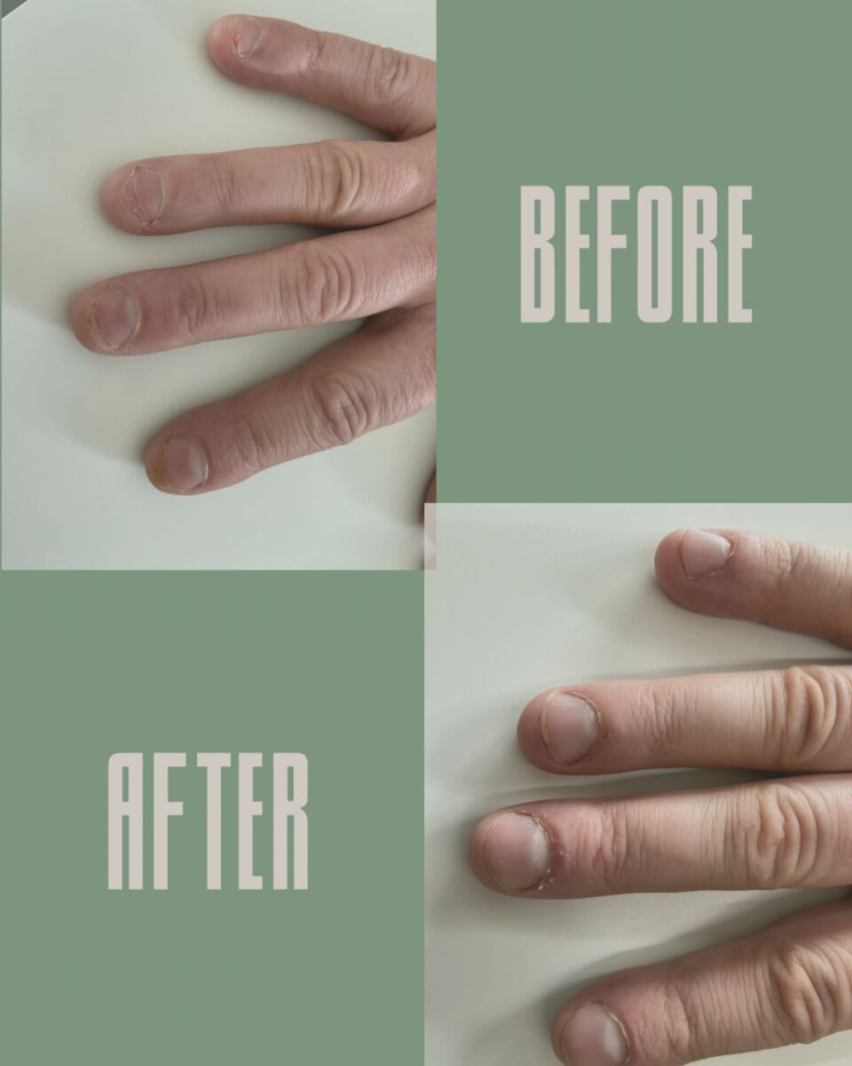 Höre mittels Hypnose auf an deinen Nägeln und Haut zu kauen oder zu reißen. Zwischen diesen beiden Fotos liegen knappe 3 Wochen, der Erfolg ist klar sichtbar. 
Kaust du auch immer wieder unbewusst die Nägel ab - obwohl du schon längst damit aufhören wolltest? Viele Menschen leiden unter dieser hartnäckigen Angewohnheit, die oft aus Stress, Nervosität, Langeweile usw. entsteht. Schämst du dich wegen abgekauter Fingernägel? Leidest du unter eingerissener und entzündeter Nägel und Haut? 
Hypnose bei Nägelkauen bietet Dir eine echte Chance, diese lästige Gewohnheit nachhaltig loszuwerden - ohne Zwang und Druck. Statt dich immer wieder selbst zu sabotieren, nütze die Kraft deines Unterbewusstseins für diese positive Veränderung.
Du willst wieder mit Stolz auf deine Hände schauen? Informiere dich gerne bei mir! 
#hypnose #nägelkauen #hypnosesitzung #badleonfelden #hypnosepraxis